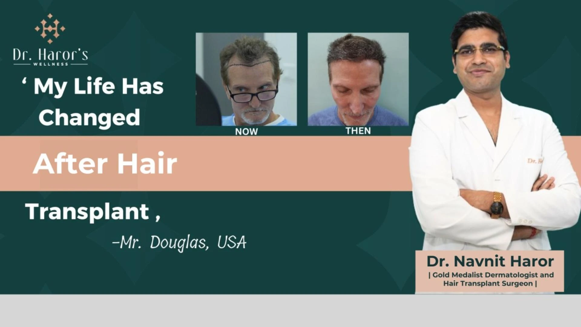 Amazing Hair transplant Result in 6 months: A case study of Caucasian Hair transplant candidate with Grade III baldness