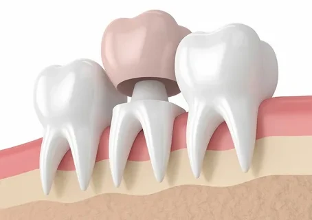 Dental Crowns vs Veneers: Choosing the Right Option