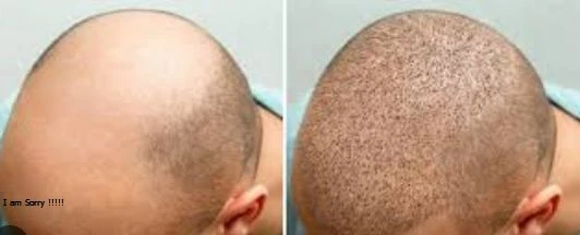 Incredible Hair Transplant Turkey Before and After Transformations