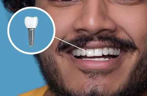 Dental implants Al Mussafah