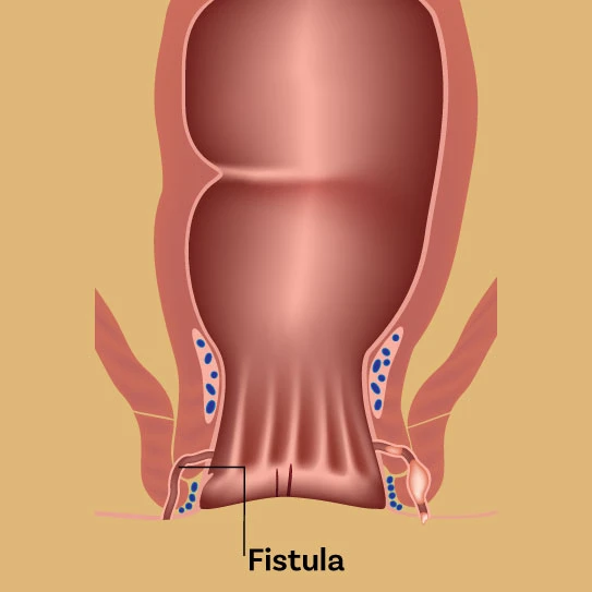 Navigating Atrioventricular Fistula Treatment: A Journey Through India's Advanced Healthcare Landscape