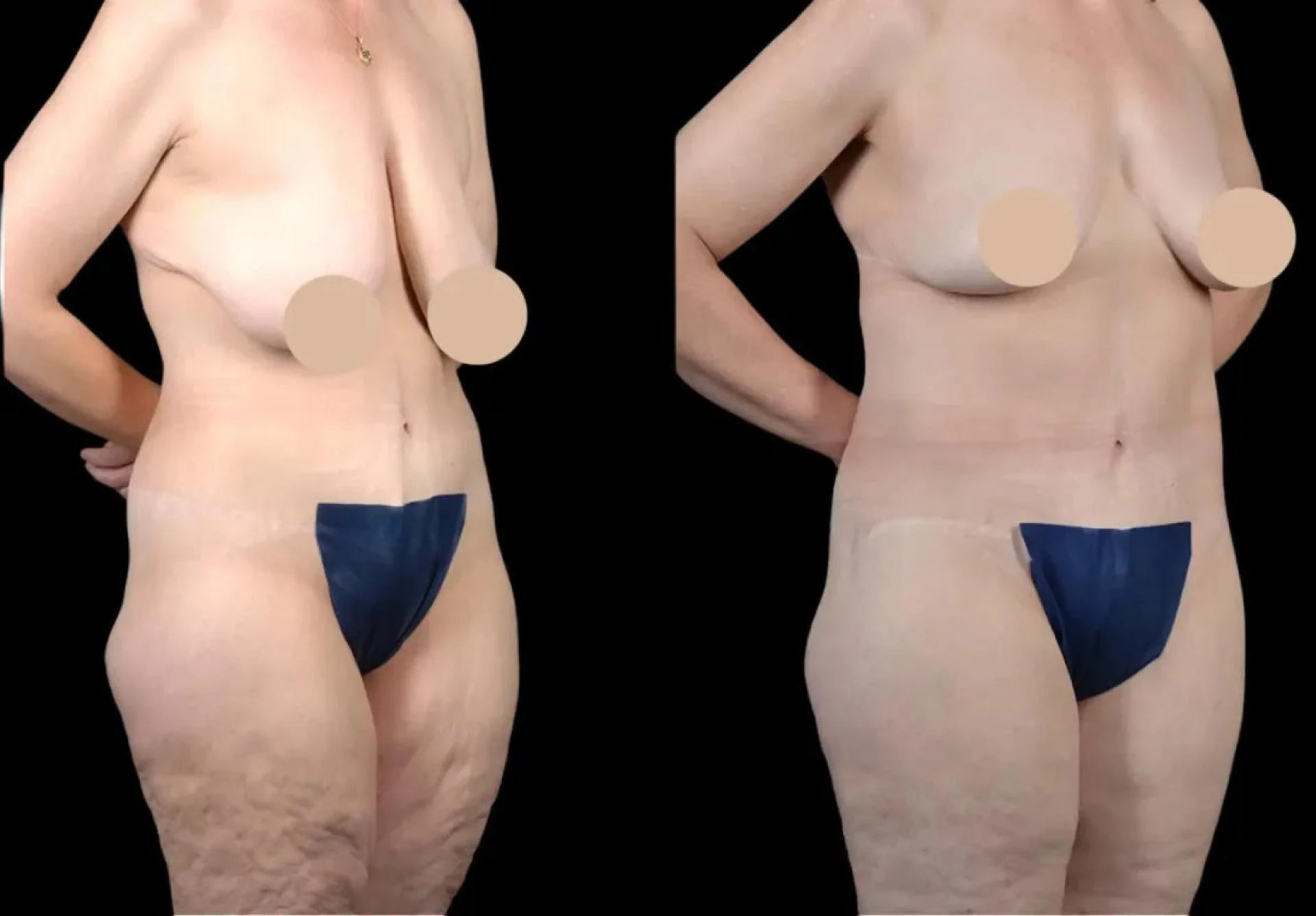 How to Prepare for Thigh Lift Surgery in Dubai