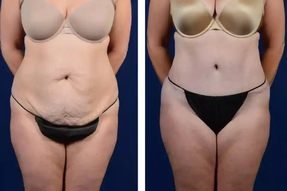 The Evolution of Mommy Makeovers: Latest Trends and Innovations