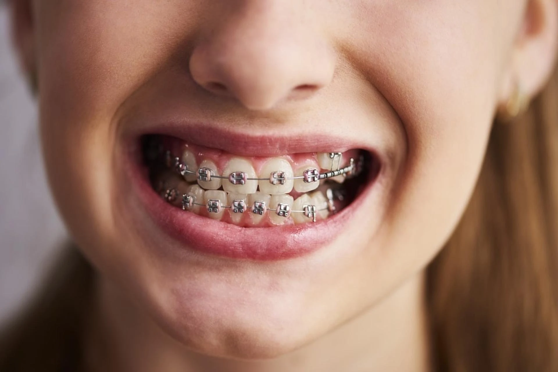 Should You Consider Damon Braces?