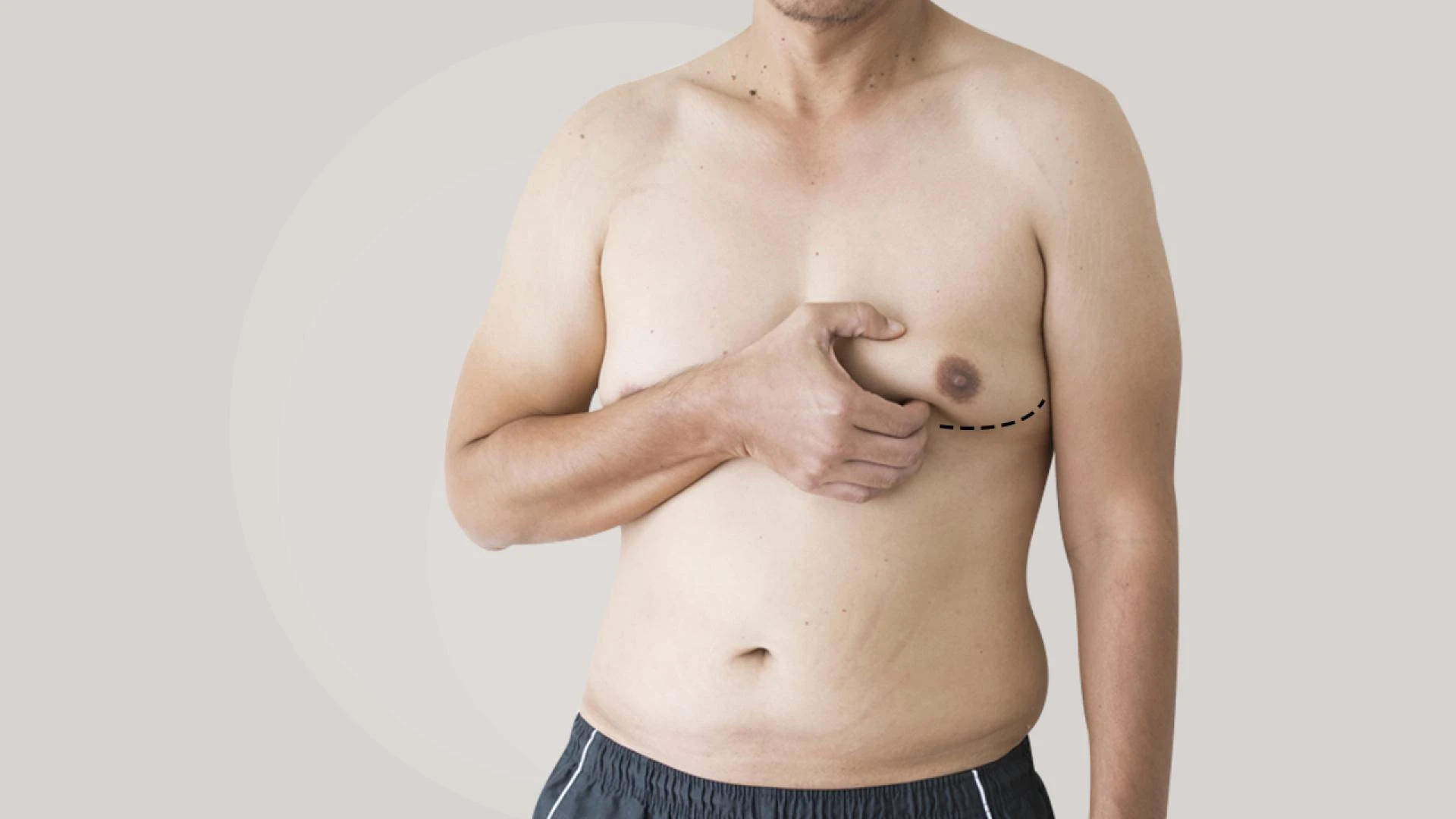 The Differences Between Chest Fat and Gynecomastia
