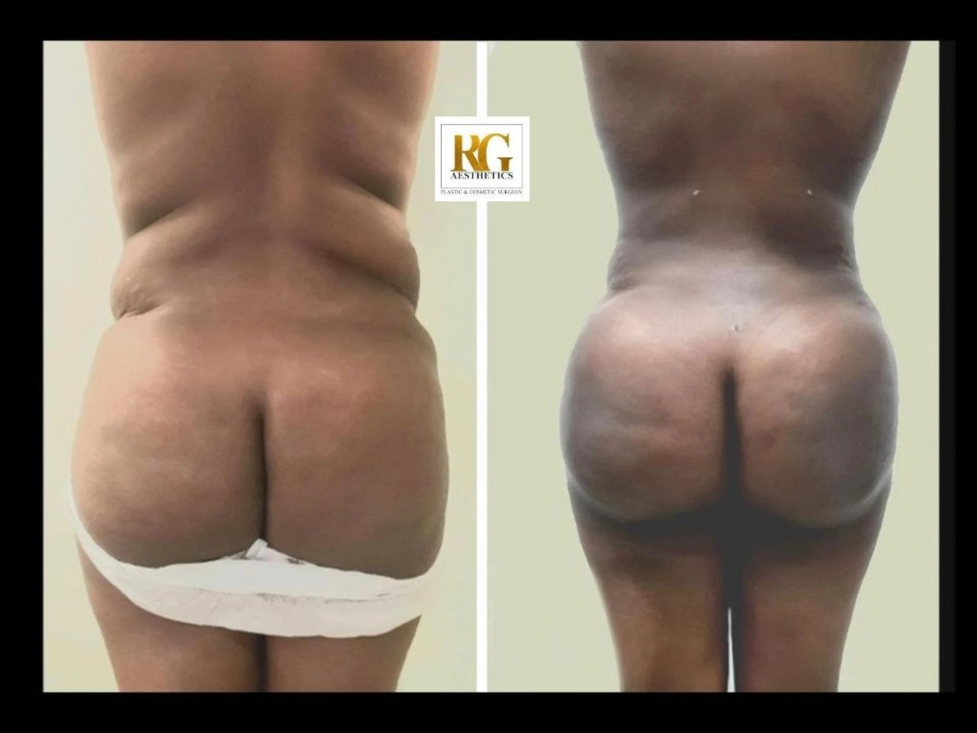 Buttock Augmentation Procedure in Delhi