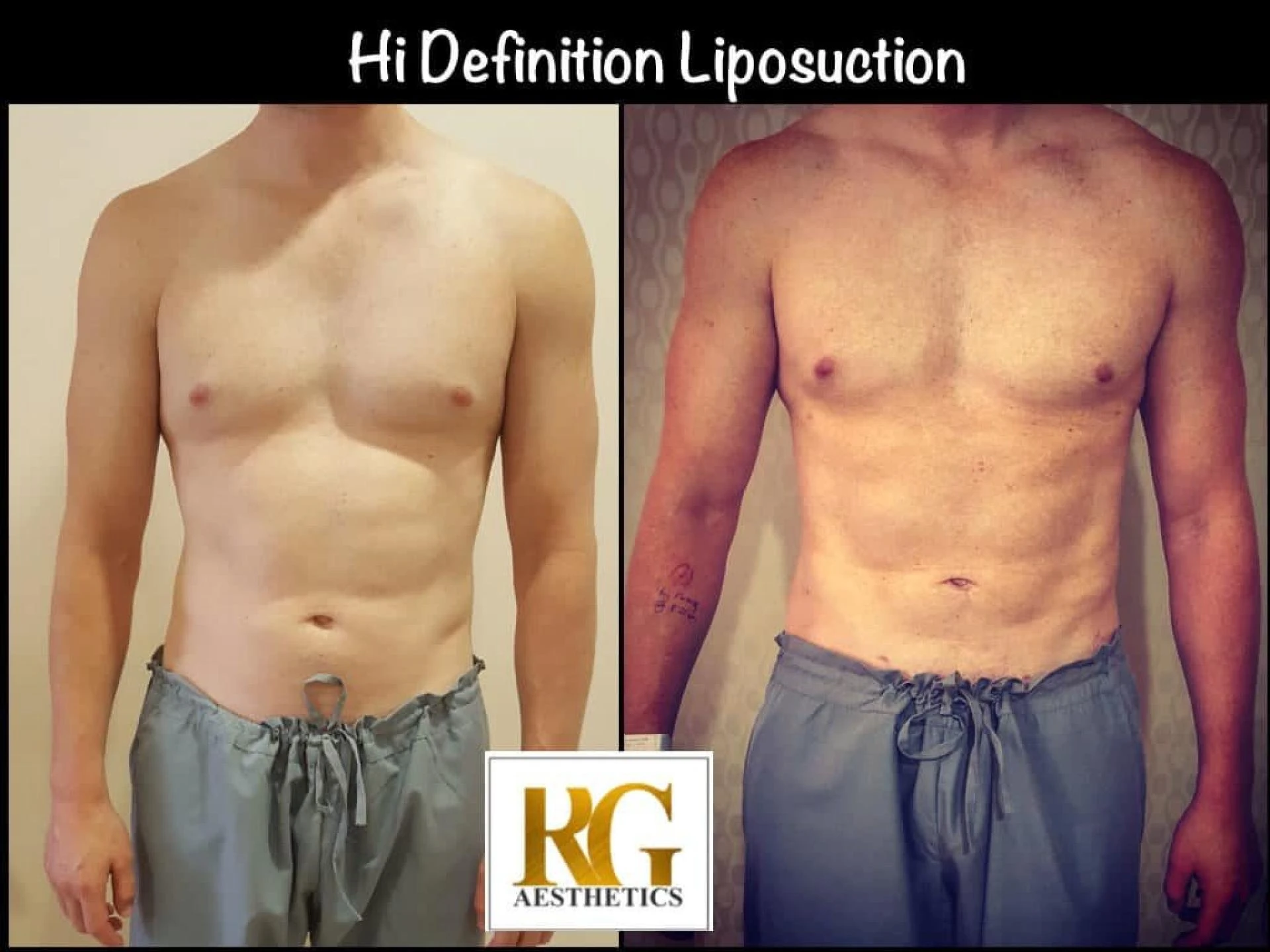 This New Plastic Surgery Technique Turns Belly Fat into Abs