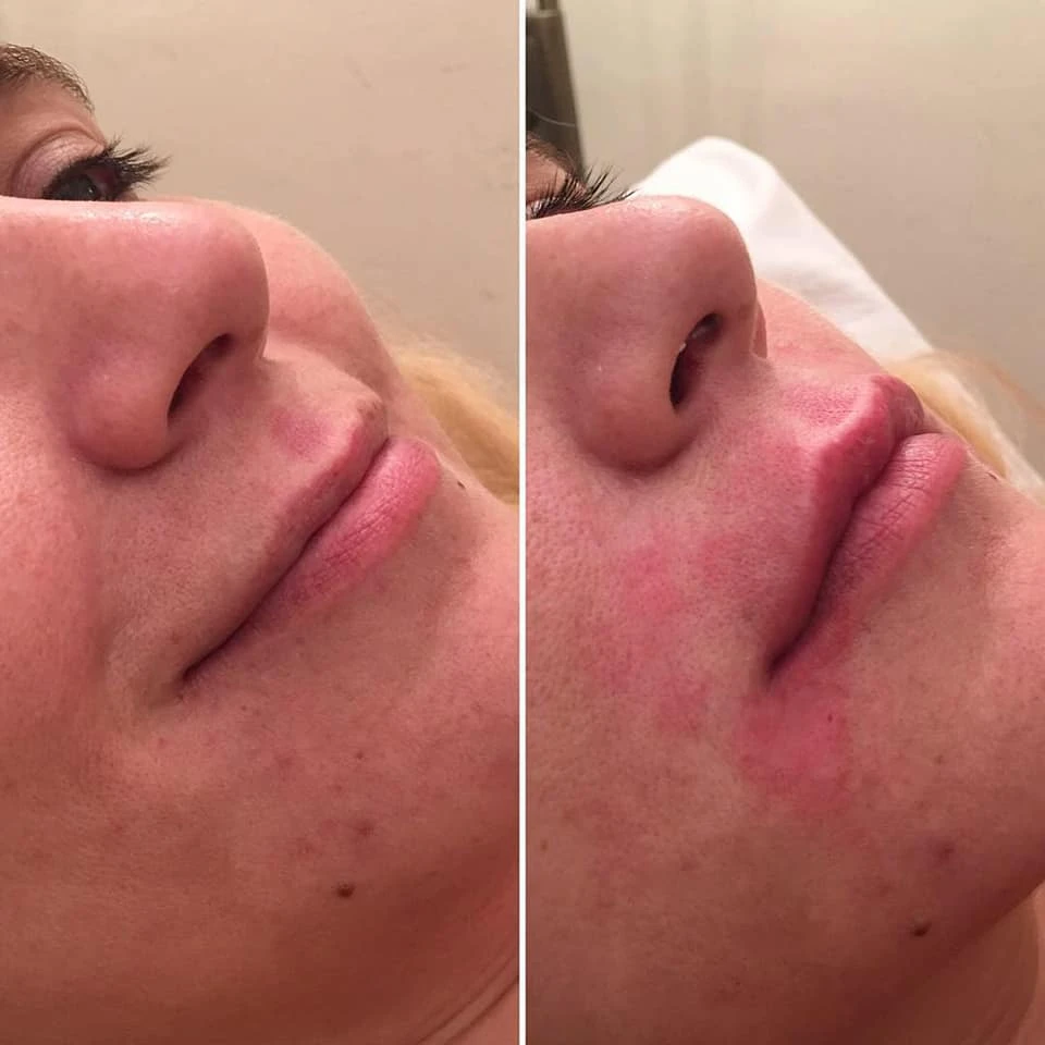 Botox Treatment in London | Fortes Clinic