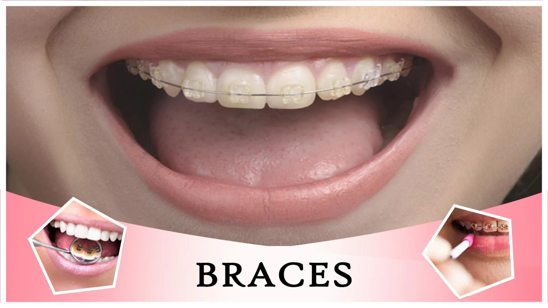 What Is A Good Age To Get Braces?