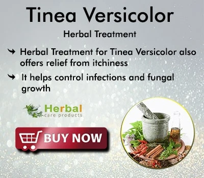Herbal Treatment for Tinea Versicolor | Remedies | Herbal Care Products