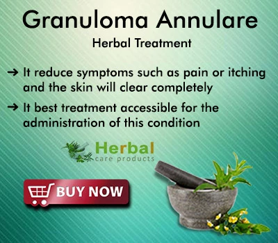 Best Way to Treat Granuloma Annulare Naturally at Home