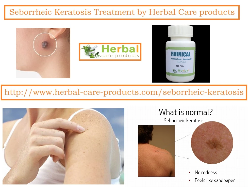 10 Natural Remedies for Seborrheic Keratosis - Herbal Care Products