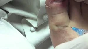 How Podiatrist Remove Ingrown Toenail