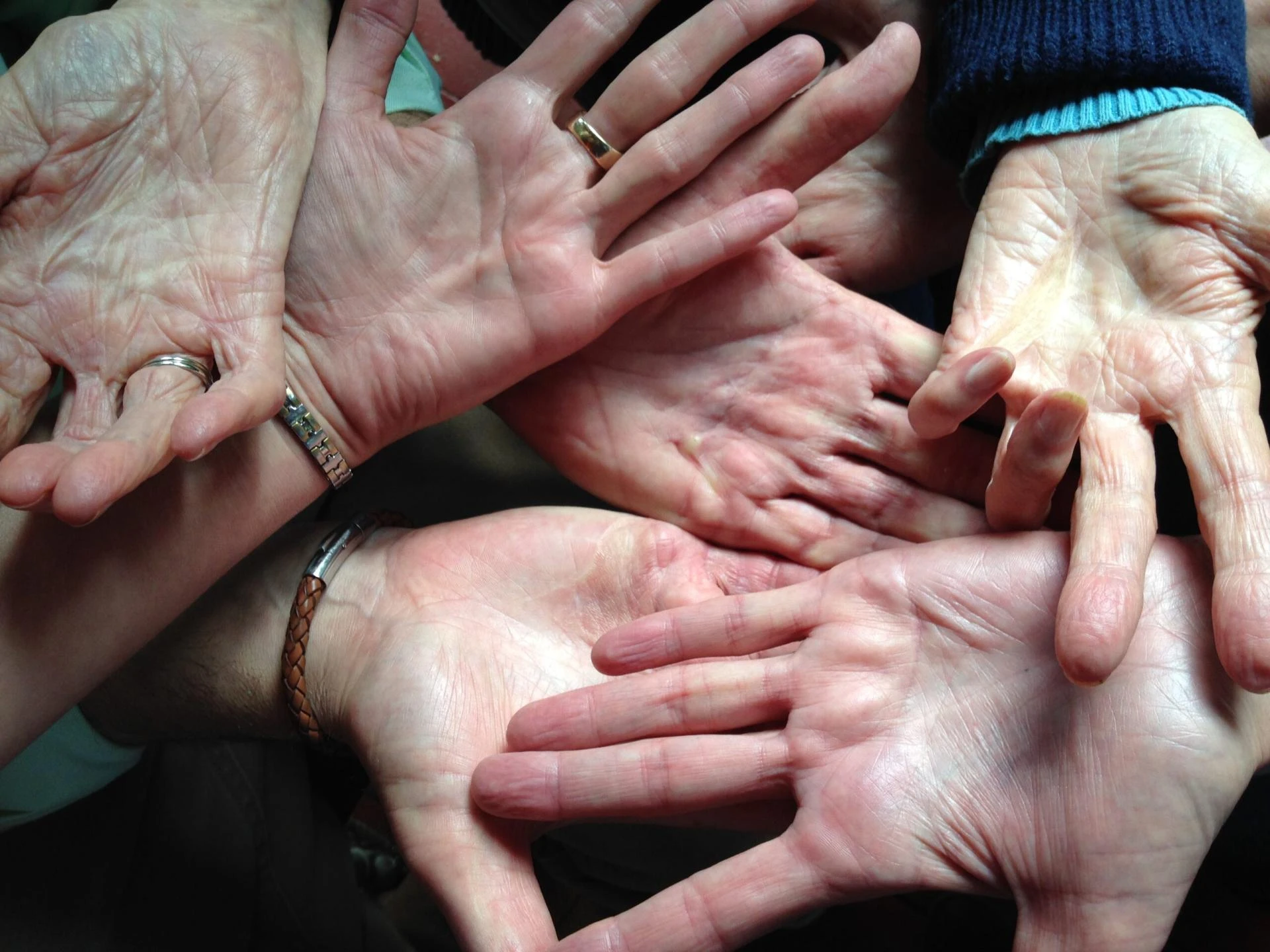 New Surgical Alternative For Dupuytren’s Disease Sufferers
