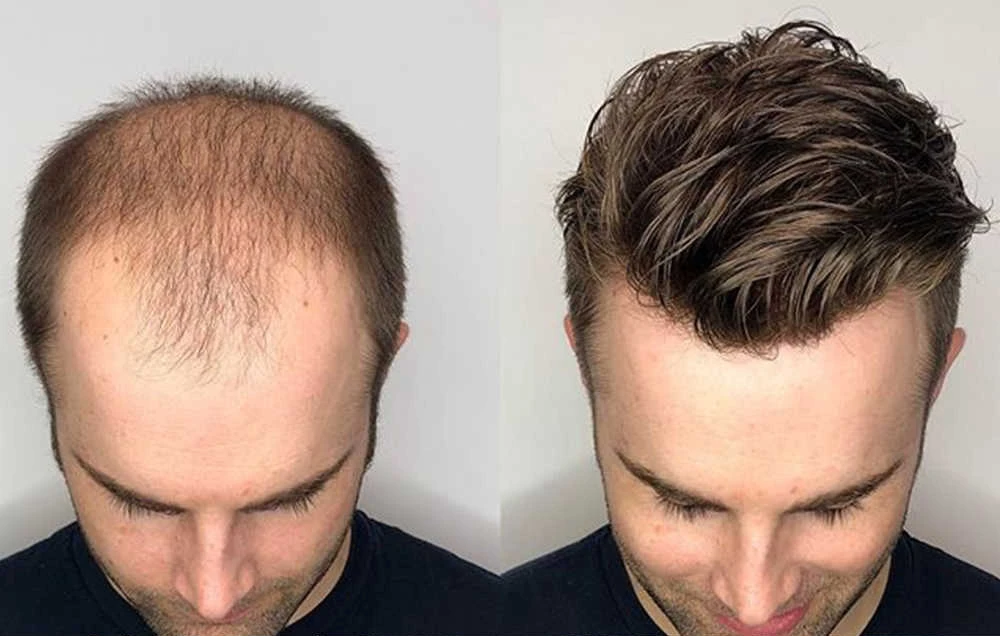 These mens hair pieces will surprise you.