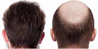 Tips for Hair Care Post Hair Transplant