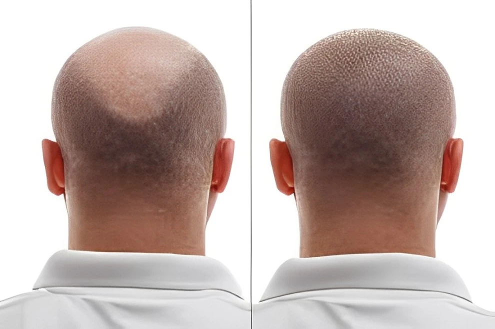 FUE Hair Transplant: Debunking Common Myths and Misconceptions