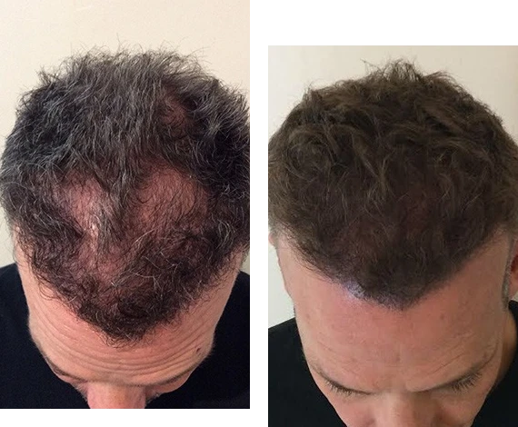 Non-Surgical Hair Replacement in Bangalore-Wigs replacement Center