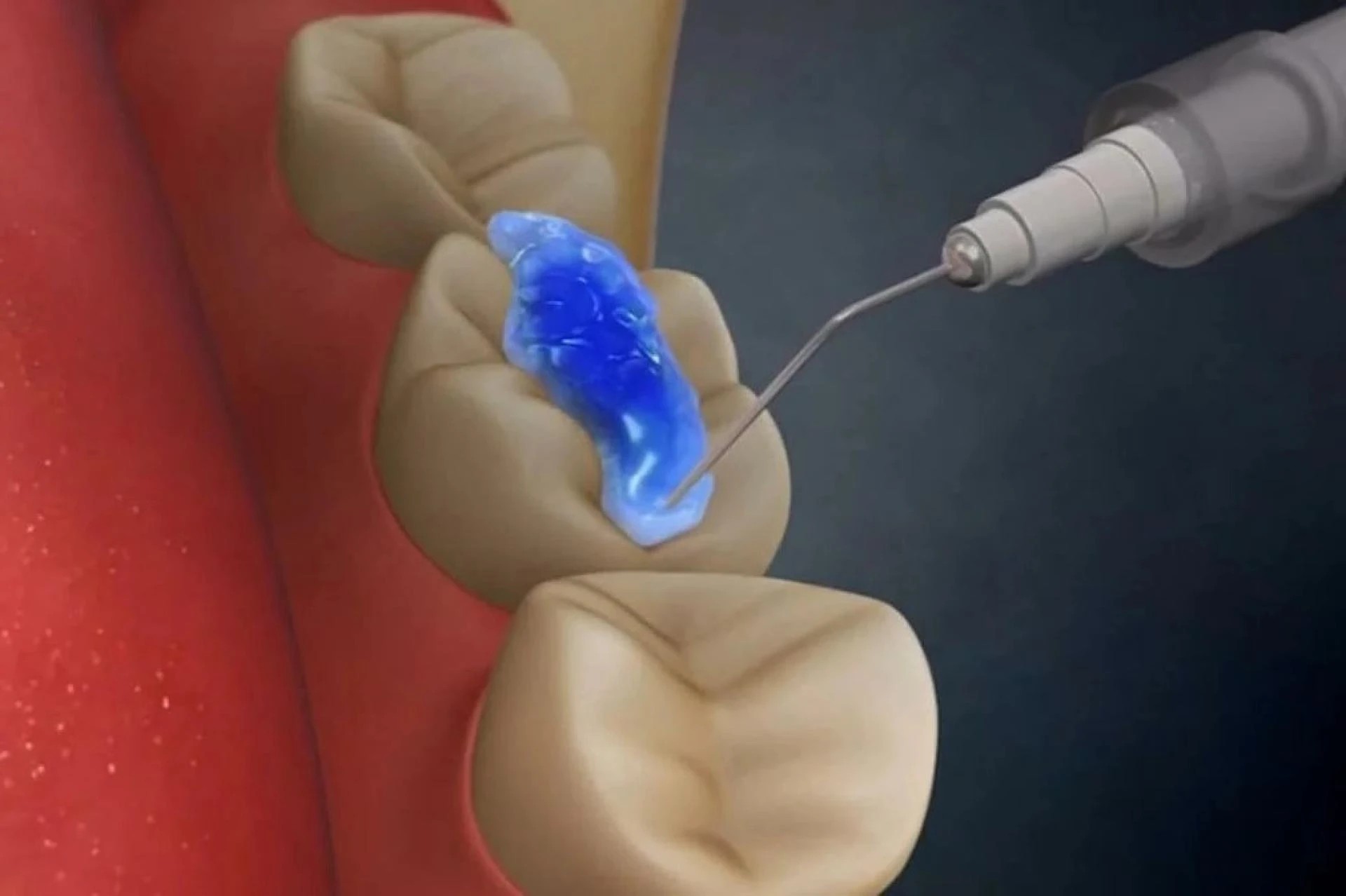 Best Dentist for General Dentistry in Bangalore - Dental Solutions