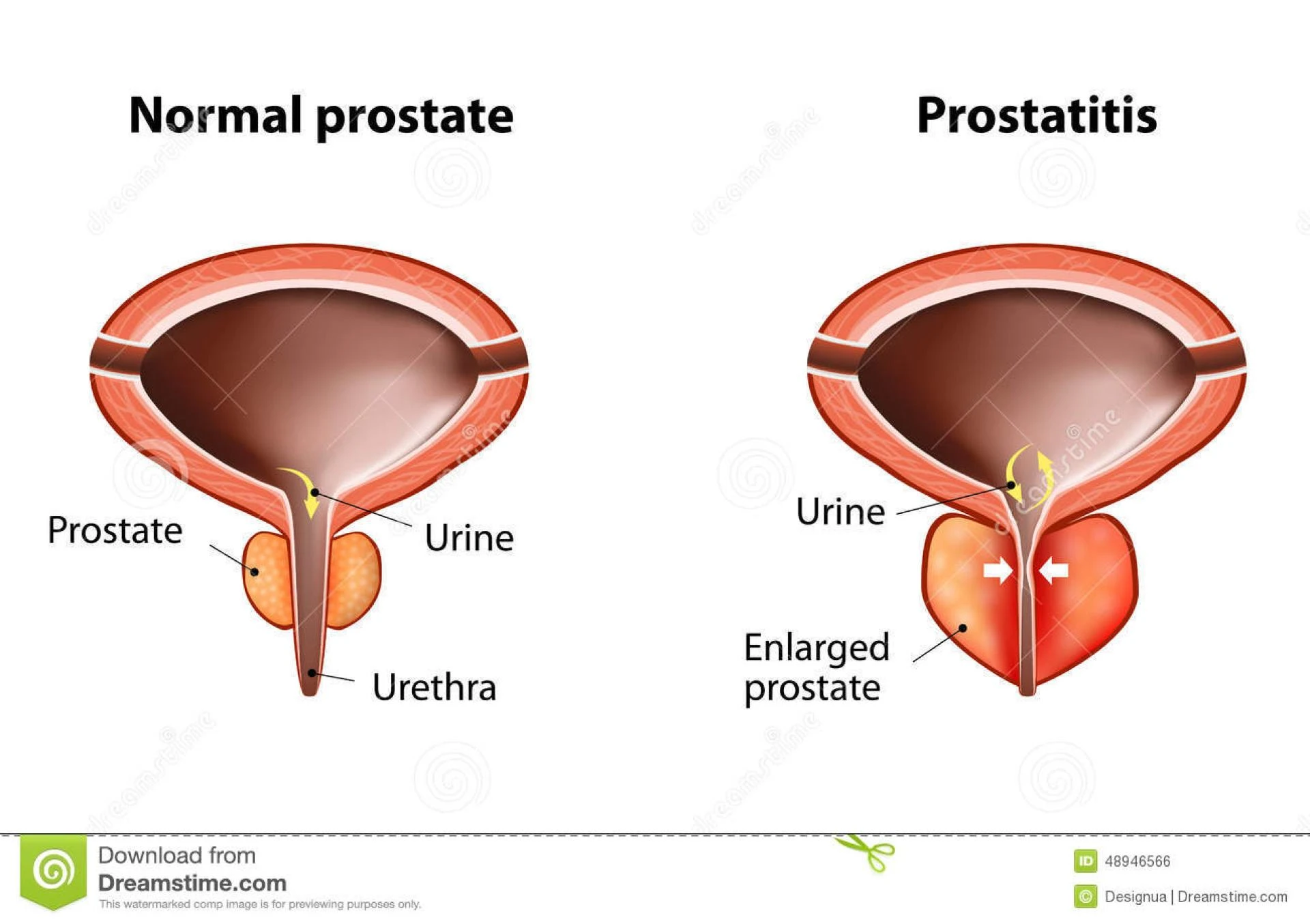 Prostat çayı nasıl demlenir