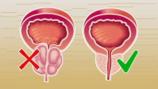 Kronik prostatit engel oranı