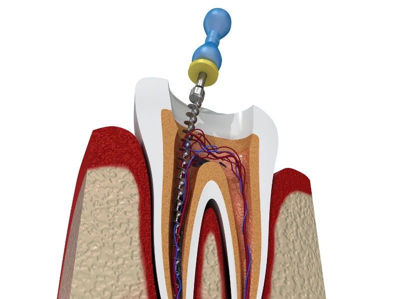 Is a Root Canal Really Painful? What You Need to Know