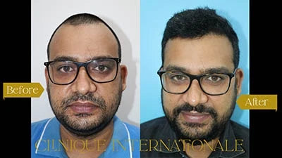 The Advantages of Hair Transplant in Mumbai