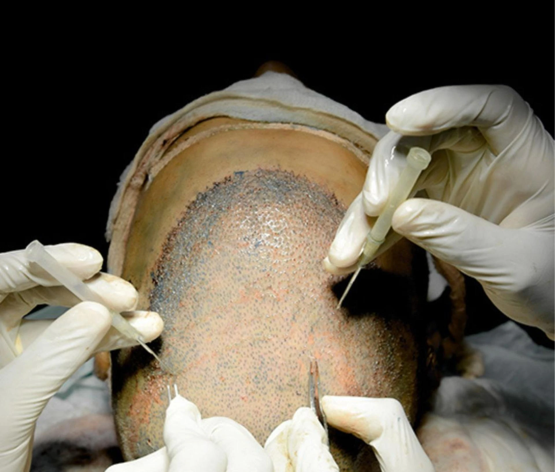 Why QHT Clinic is the Top Hair Transplant Clinic in India for Natural, Long