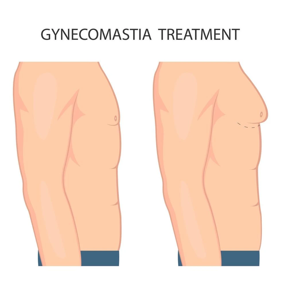 Who Needs Gynecomastia Surgery? Signs You Shouldn’t Ignore