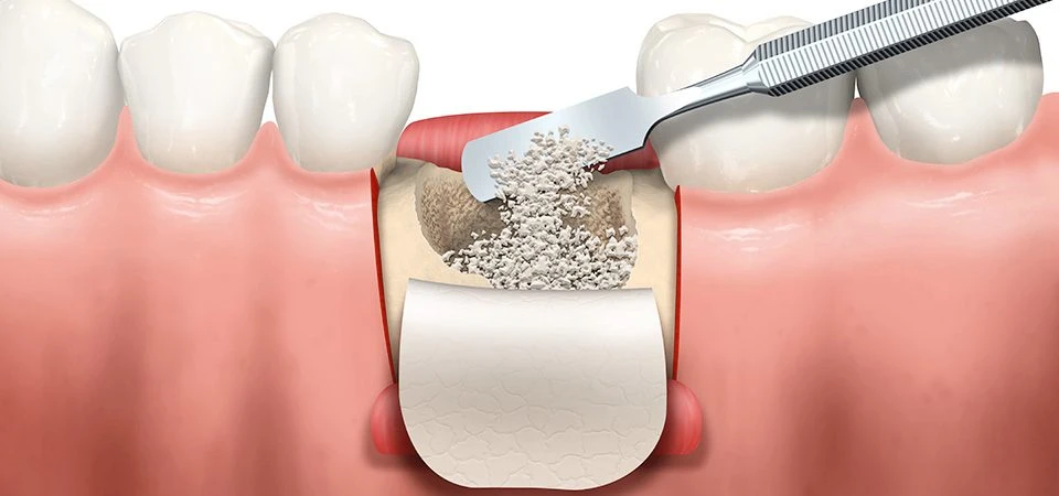 What Is Bone Grafting for Implants and Why Is It Necessary?