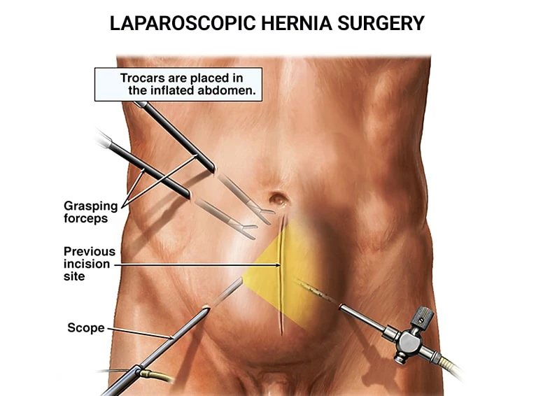 Expert Hernia Surgery in Riyadh: Trust Our Skilled Surgeons for Your Recovery