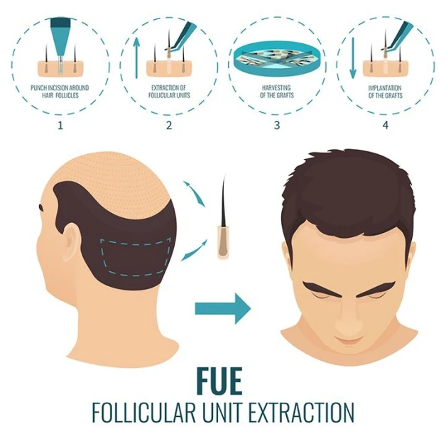 Transform Your Look with FUE Hair Transplant in India at QHT Clinic