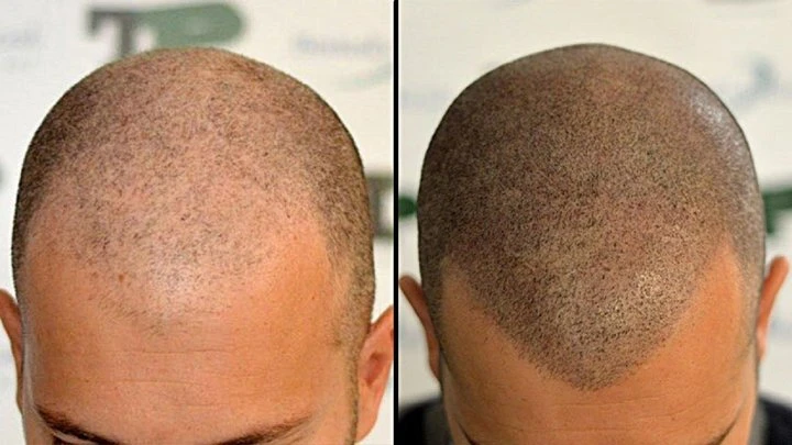 Scalp Micro Pigmentation: A Complete Guide to Hair Loss Solution