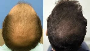Transform Your Look with a Hair Transplant in Riyadh