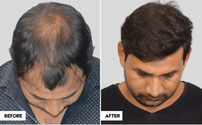 The Real Cost of Hair Transplant in India: A Guide by QHT Hair Transplant Clinic