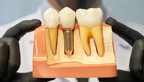 Dental implants in Al ain | Darqoon