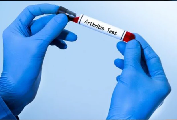 Understanding the Importance of Arthritis Test in Dombivli at Eureka Pathology Lab