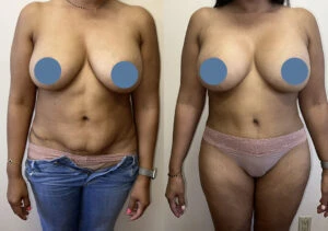 Reclaim Your Confidence with a Mommy Makeover Los Angeles