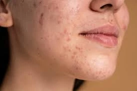 Transform Your Skin with Laser Acne Treatment at DermAura