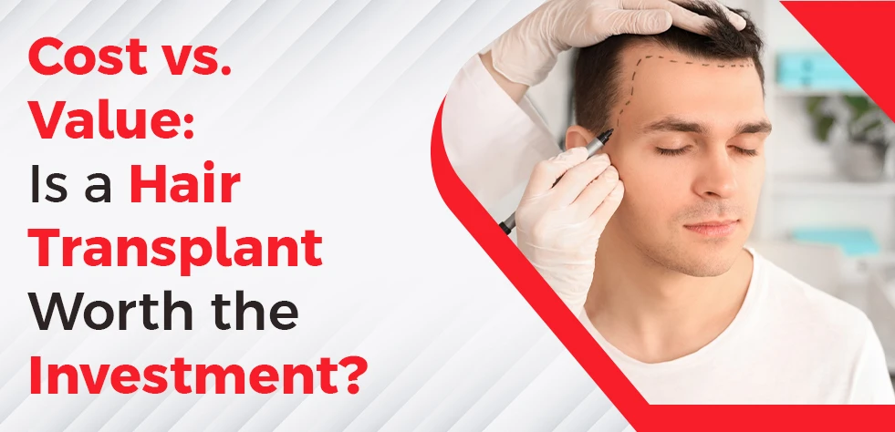 Cost vs. Value: Is a Hair Transplant Worth the Investment?