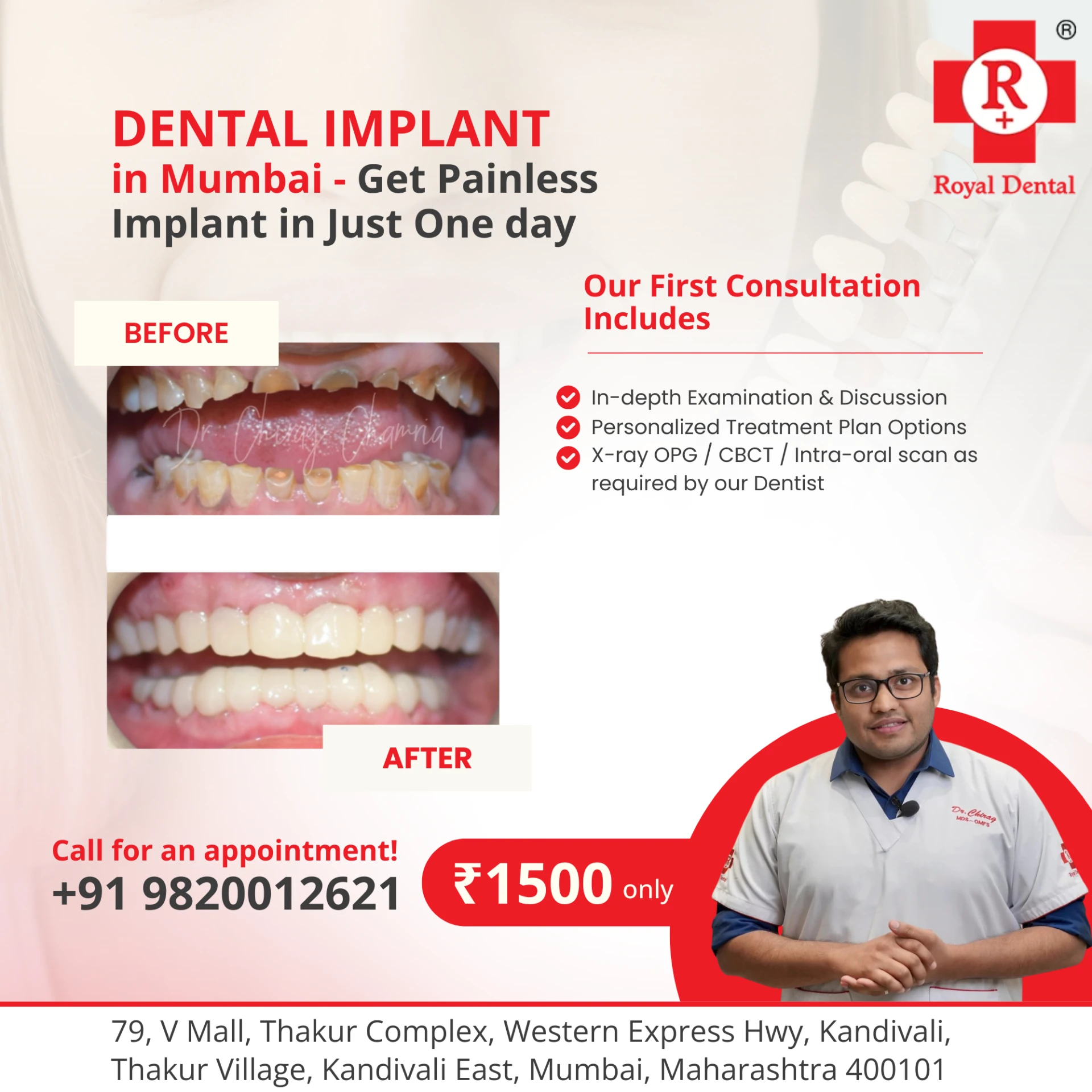 Root Canal In Kandivali