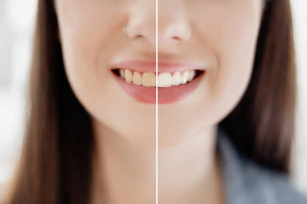 Brighten Your Smile with Professional Teeth Whitening Services