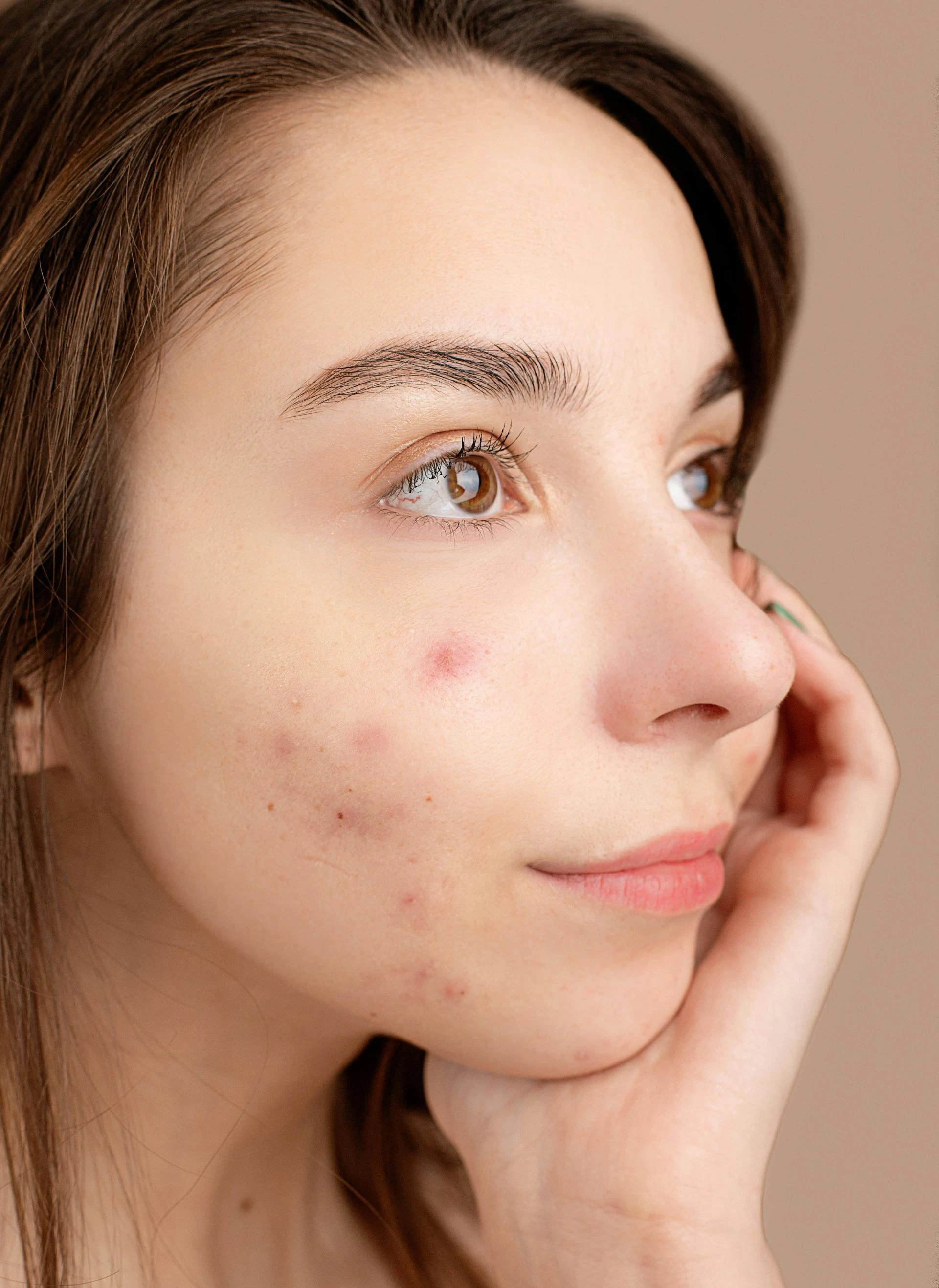  My Post From Breakouts to Brilliance: Your Ultimate Acne GuideTitle