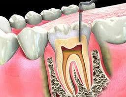 Expert Root Canal Treatment in Indiranagar: A Complete Guide to Healthy Smiles
