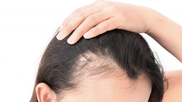 Female Hair Transplant: Transforming Lives at QHT Hair Transplant Clinic