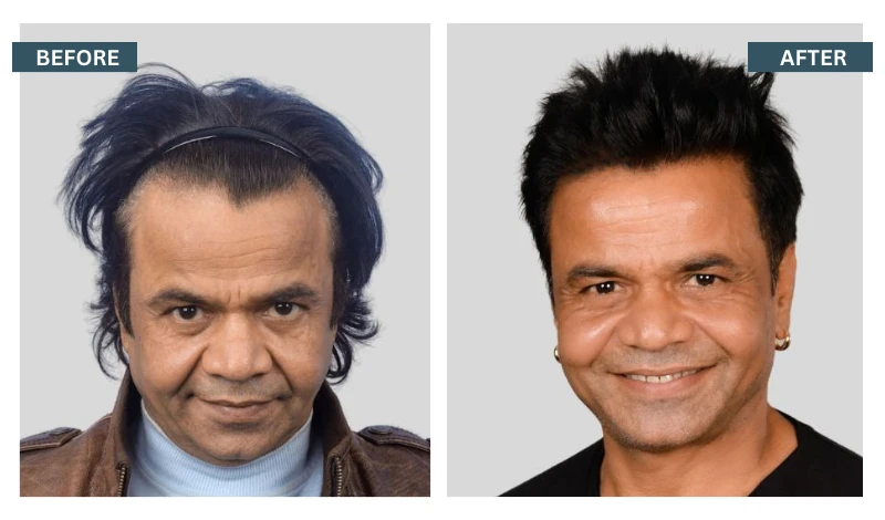 FUE Hair Transplant Cost in India at QHT Clinic