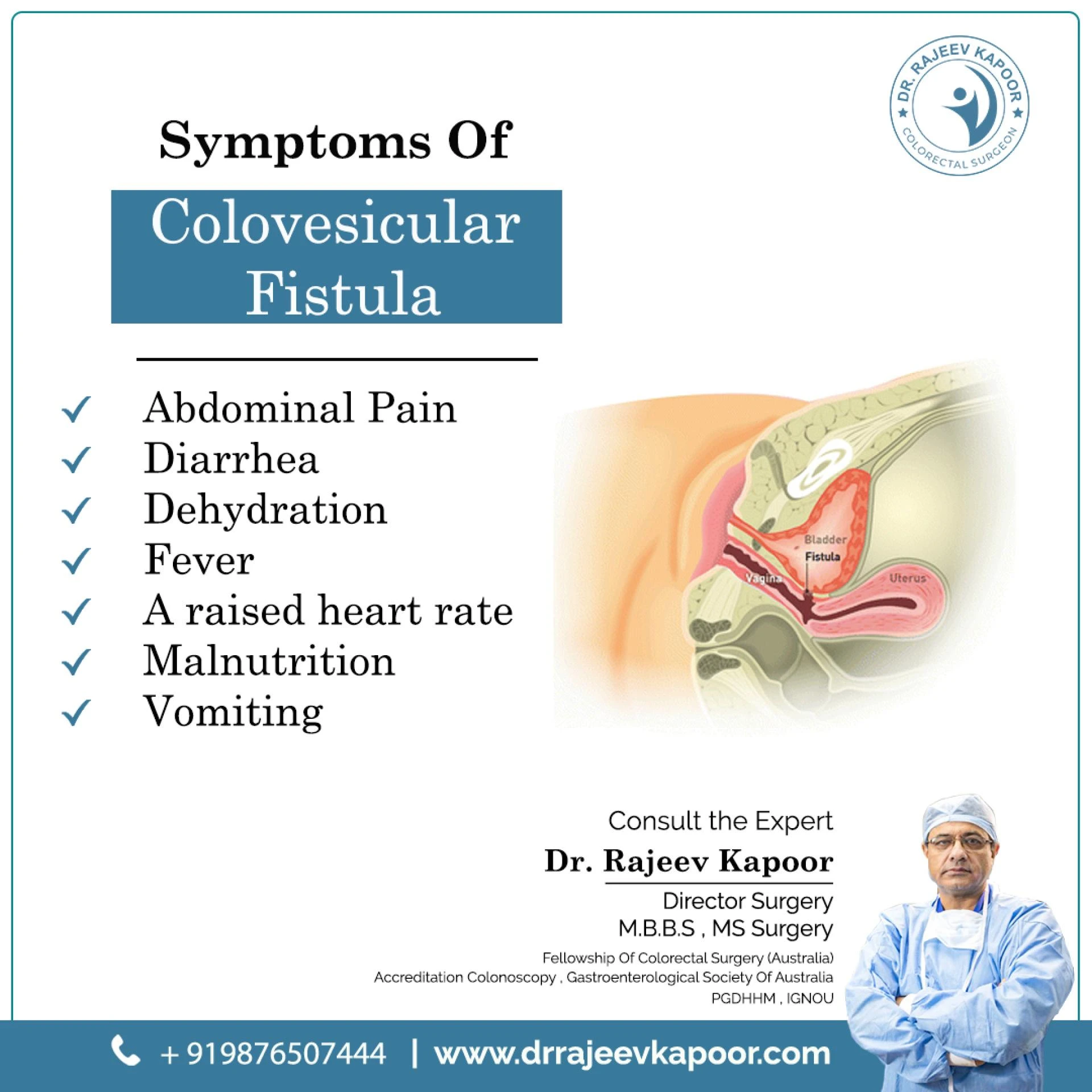 Expert Fistula Treatment in Chandigarh with Dr. Rajeev Kapoor