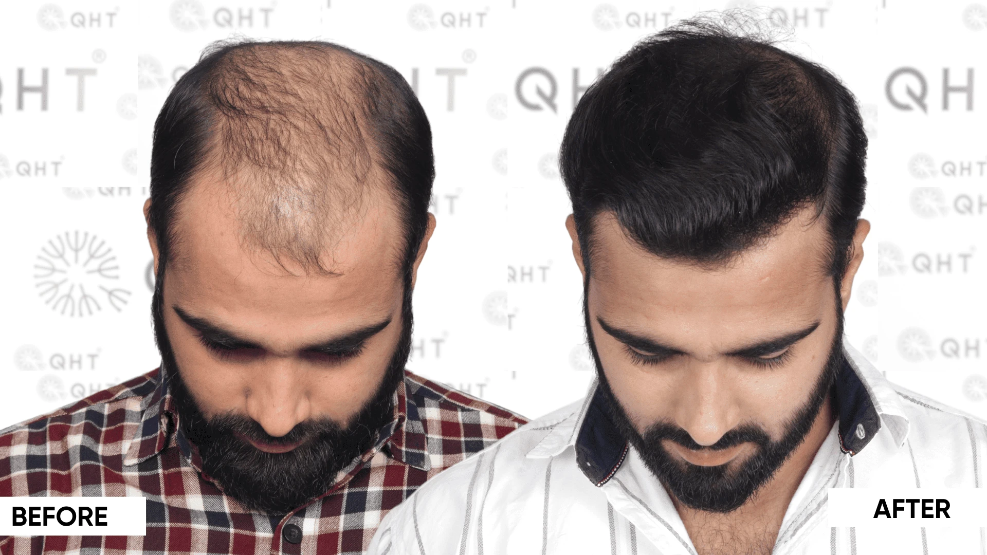 Affordable Body Hair Transplant Cost in India - QHT Clinic