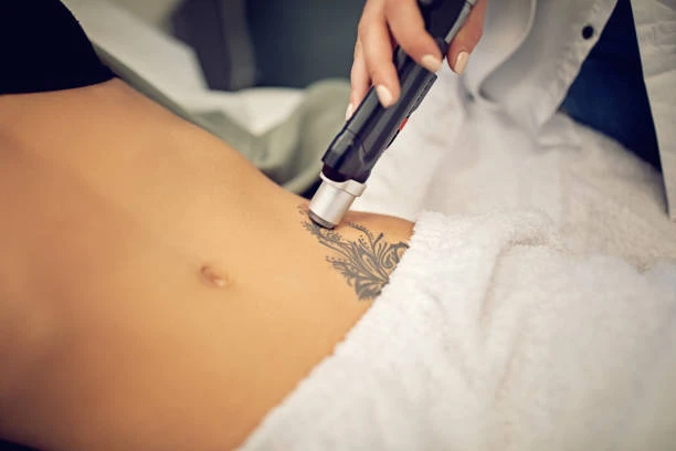 The Ultimate Guide to Laser Tattoo Removal: Everything You Need to Know