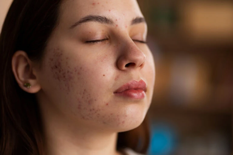 Achieve Flawless Skin with Advanced Pigmentation Removal Treatment at Dermaura